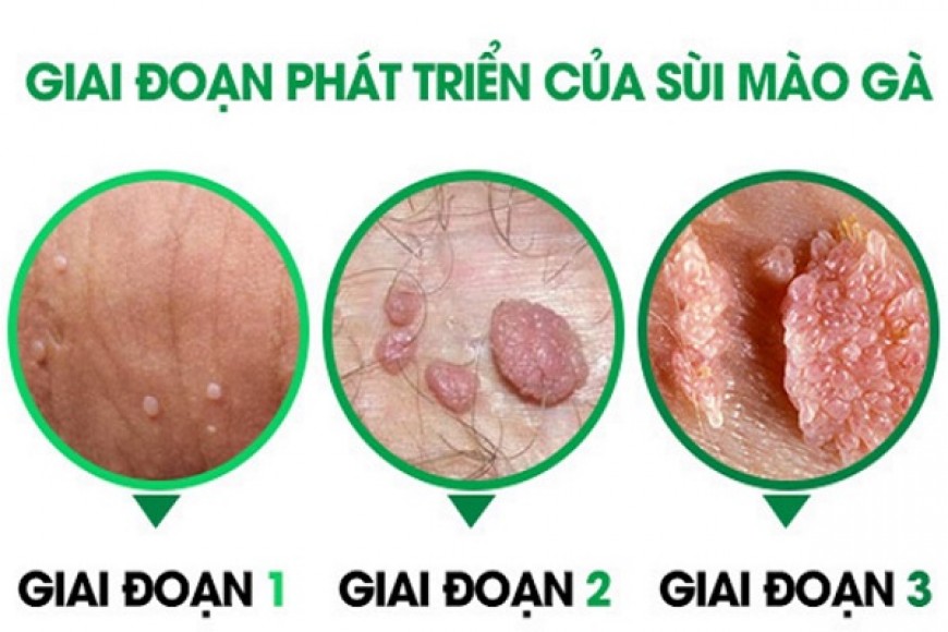 dấu hiệu sùi mào gà ở nữ